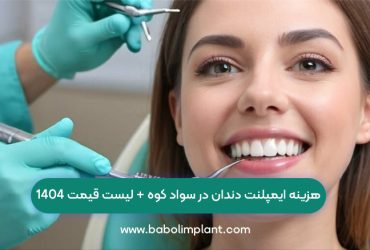 هزینه ایمپلنت دندان در سواد کوه + لیست قیمت 1404