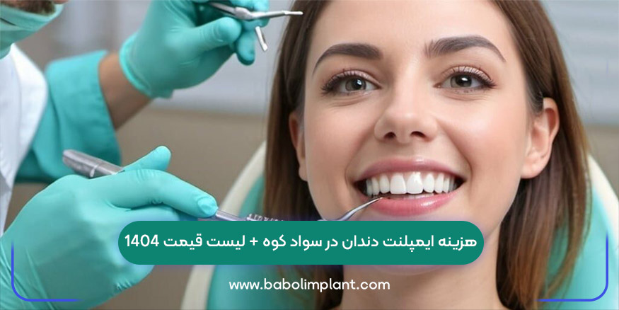 هزینه ایمپلنت دندان در سواد کوه + لیست قیمت 1404