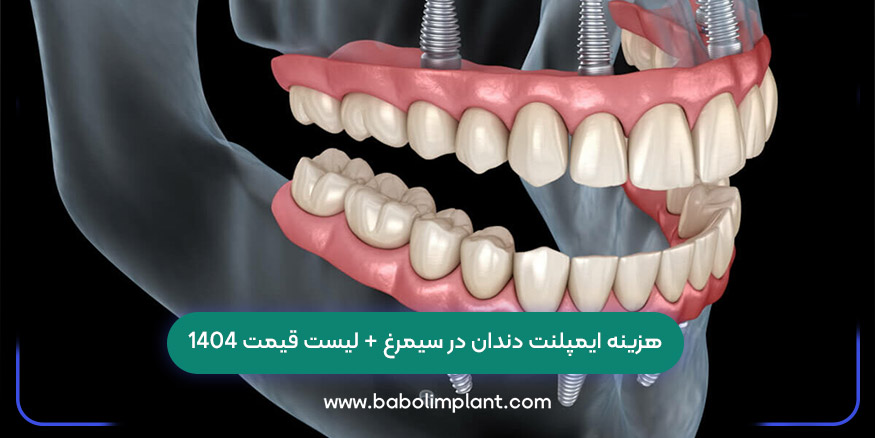 هزینه ایمپلنت دندان در سیمرغ + لیست قیمت 1404