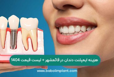 هزینه ایمپلنت دندان در قائمشهر + لیست قیمت 1404