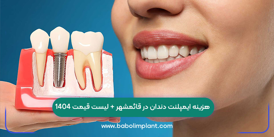 هزینه ایمپلنت دندان در قائمشهر + لیست قیمت 1404