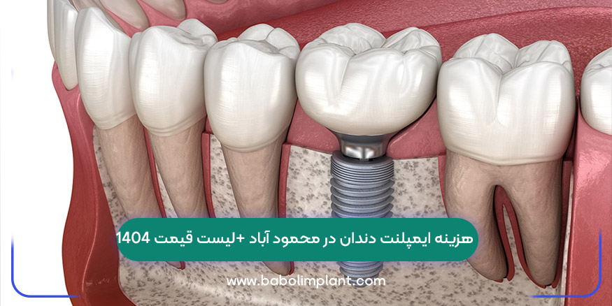 هزینه ایمپلنت دندان در محمود آباد +لیست قیمت 1404