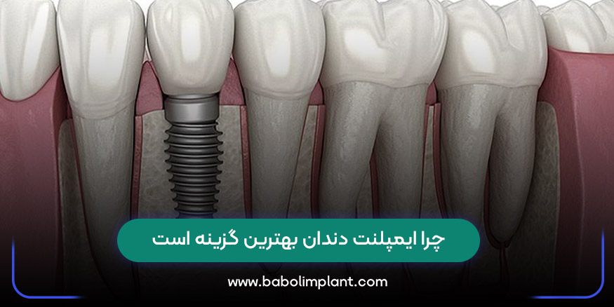 چرا ایمپلنت دندان بهترین گزینه است