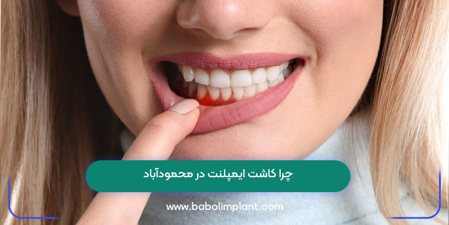چرا کاشت ایمپلنت در محمودآباد