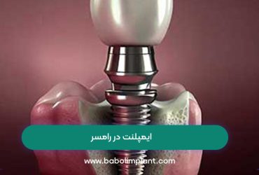 ایمپلنت در رامسر