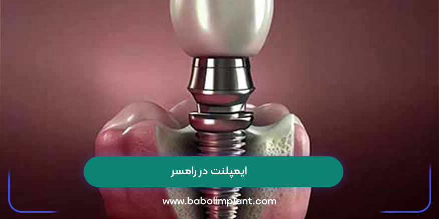 ایمپلنت در رامسر