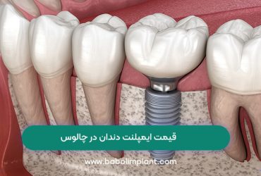قیمت ایمپلنت دندان در چالوس