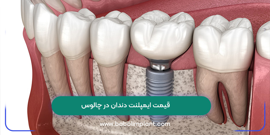 قیمت ایمپلنت دندان در چالوس