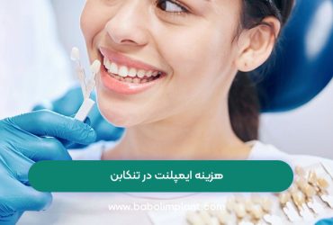 هزینه ایمپلنت در تنکابن