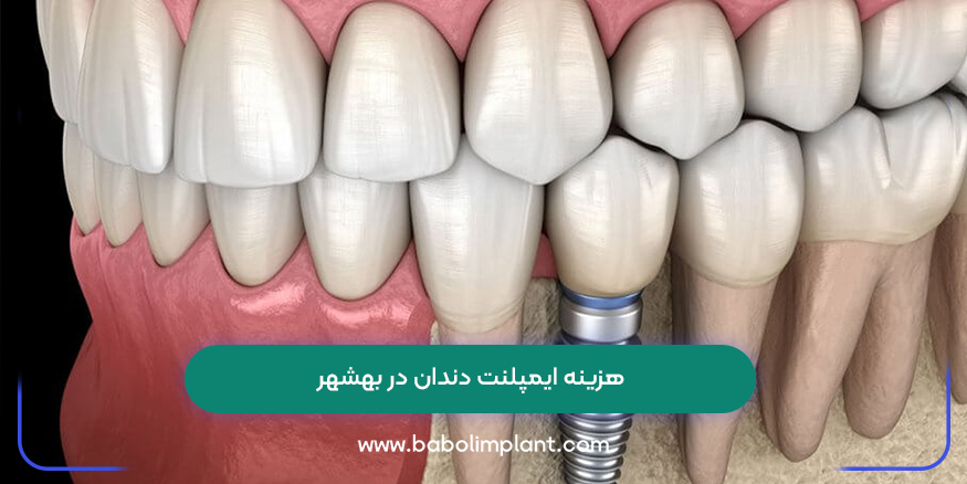 هزینه ایمپلنت دندان در بهشهر