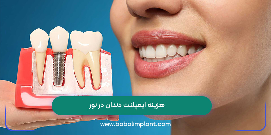 هزینه ایمپلنت دندان در نور