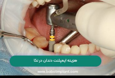 هزینه ایمپلنت دندان در نکا