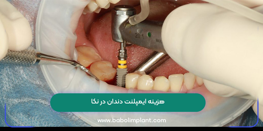 هزینه ایمپلنت دندان در نکا
