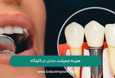 هزینه ایمپلنت دندان در گلوگاه
