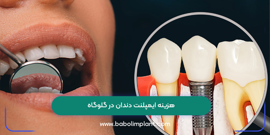 هزینه ایمپلنت دندان در گلوگاه