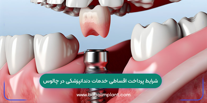 شرایط پرداخت اقساطی خدمات دندانپزشکی در چالوس
