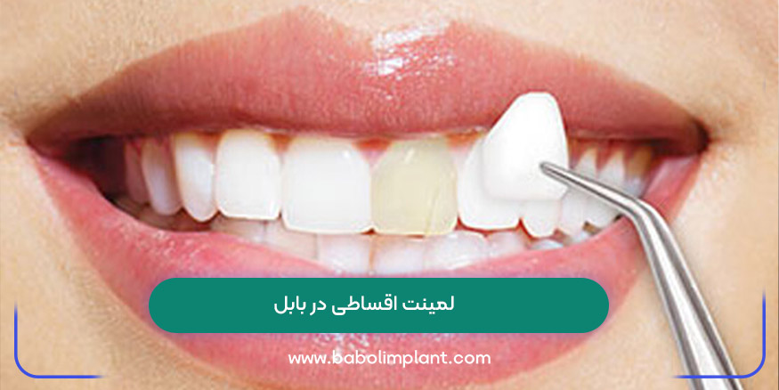 لمینت اقساطی در بابل