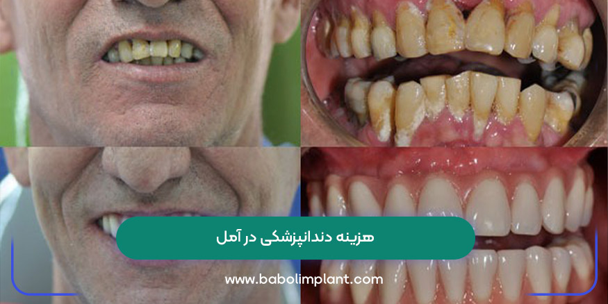 هزینه دندانپزشکی در آمل