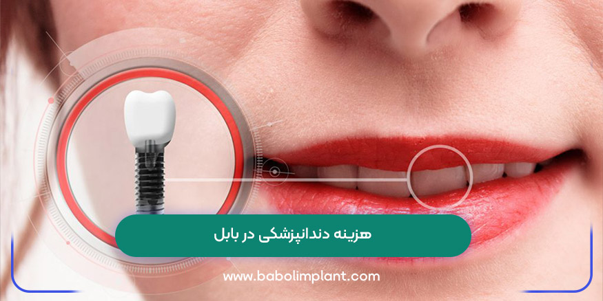 هزینه دندانپزشکی در بابل