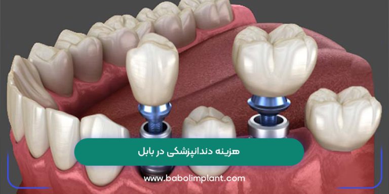 هزینه دندانپزشکی در بابل