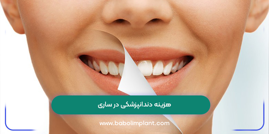 هزینه دندانپزشکی در ساری 