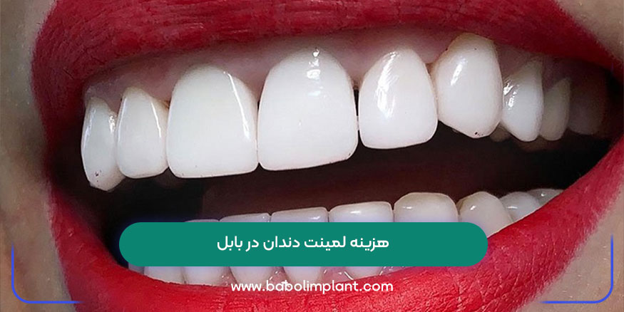 هزینه لمینت دندان در بابل