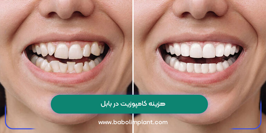 هزینه کامپوزیت در بابل