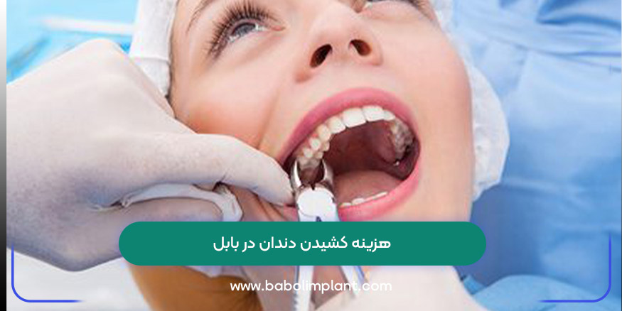 هزینه کشیدن دندان در بابل