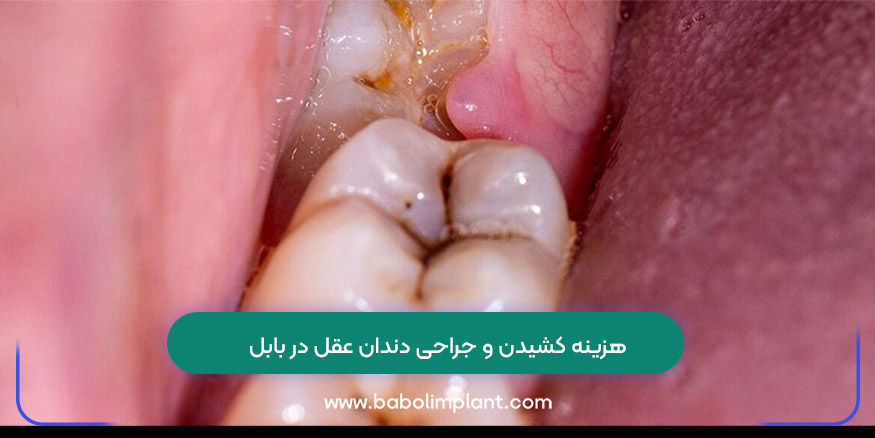 هزینه کشیدن و جراحی دندان عقل در بابل