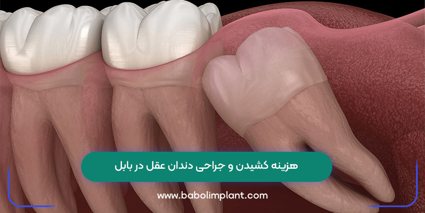 هزینه کشیدن و جراحی دندان عقل در بابل 