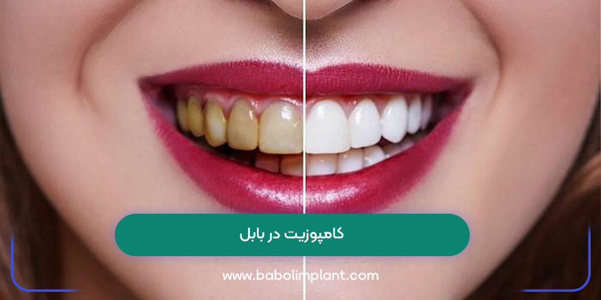 کامپوزیت در بابل 