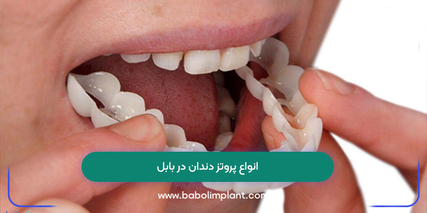 انواع پروتز دندان در بابل