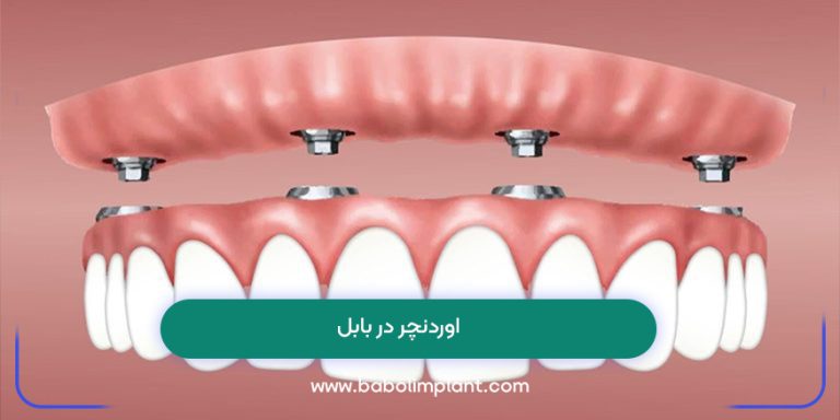 اوردنچر در بابل