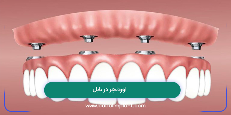 اوردنچر در بابل
