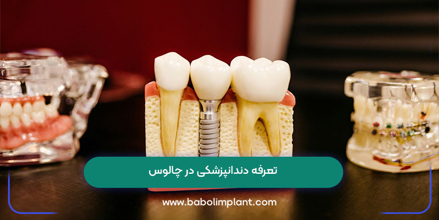 تعرفه دندانپزشکی در چالوس