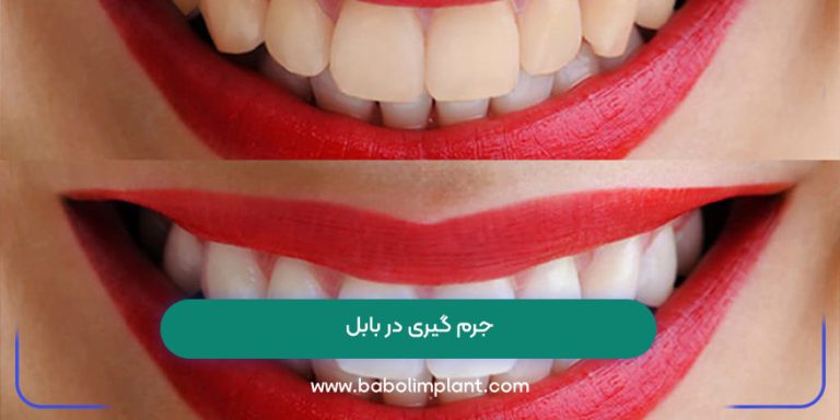 جرم گیری در بابل