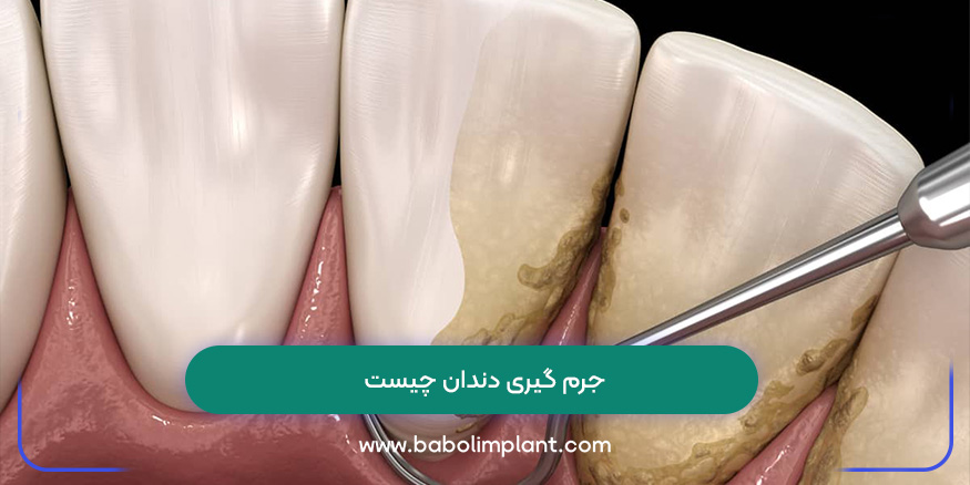 جرم گیری دندان چیست