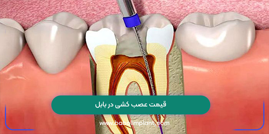 قیمت عصب کشی در بابل