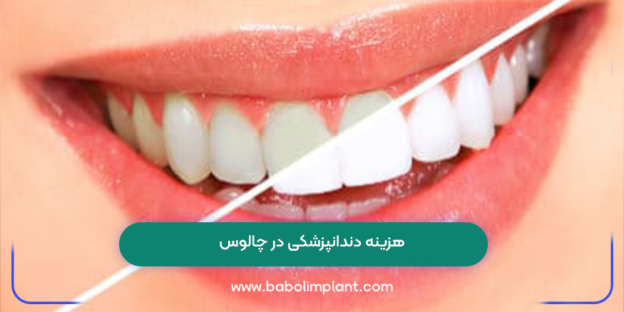 هزینه دندانپزشکی در چالوس