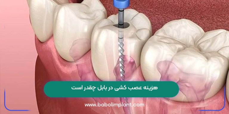 هزینه عصب کشی در بابل چقدر است