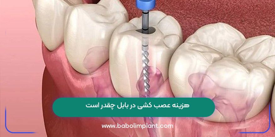 هزینه عصب کشی در بابل چقدر است