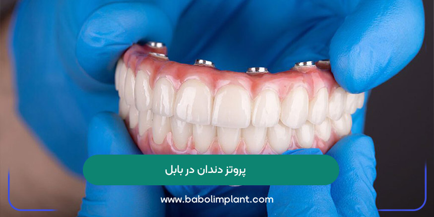 پروتز دندان در بابل