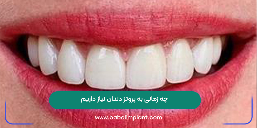 چه زمانی به پروتز دندان نیاز داریم