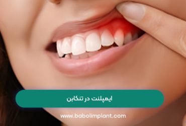 ایمپلنت در تنکابن