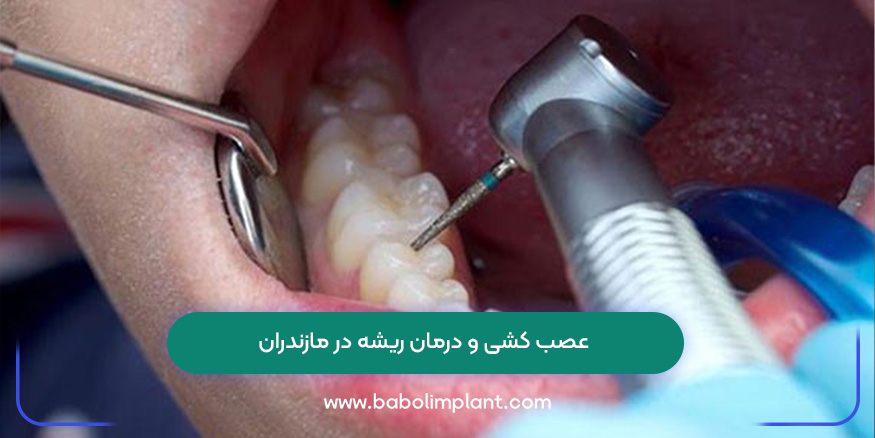 عصب کشی و درمان ریشه در مازندران