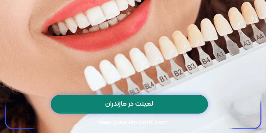 لمینت در مازندران