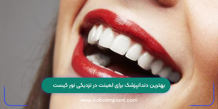 بهترین دندانپزشک برای لمینت در نزدیکی نور کیست