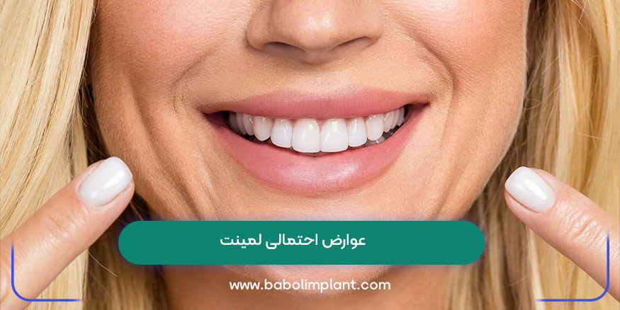 عوارض احتمالی لمینت