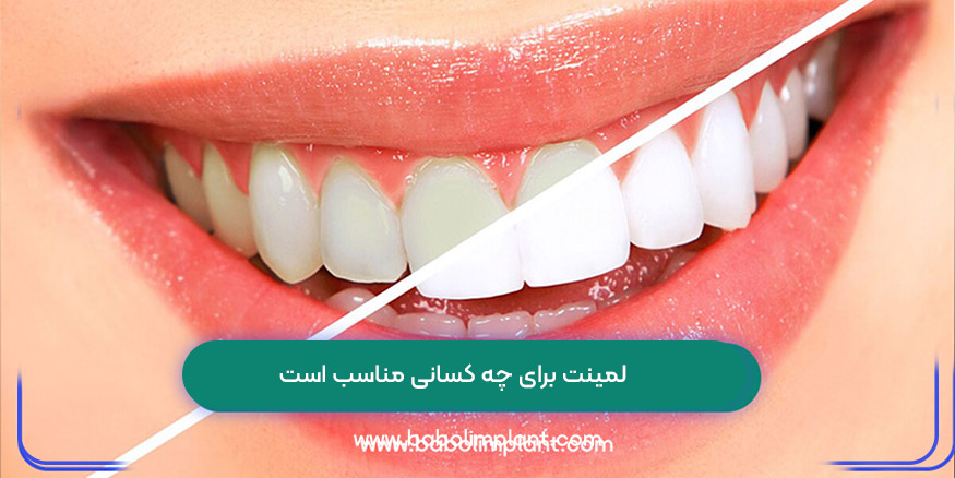 لمینت برای چه کسانی مناسب است