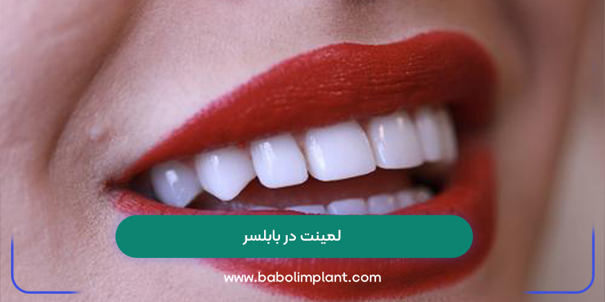 لمینت در بابلسر